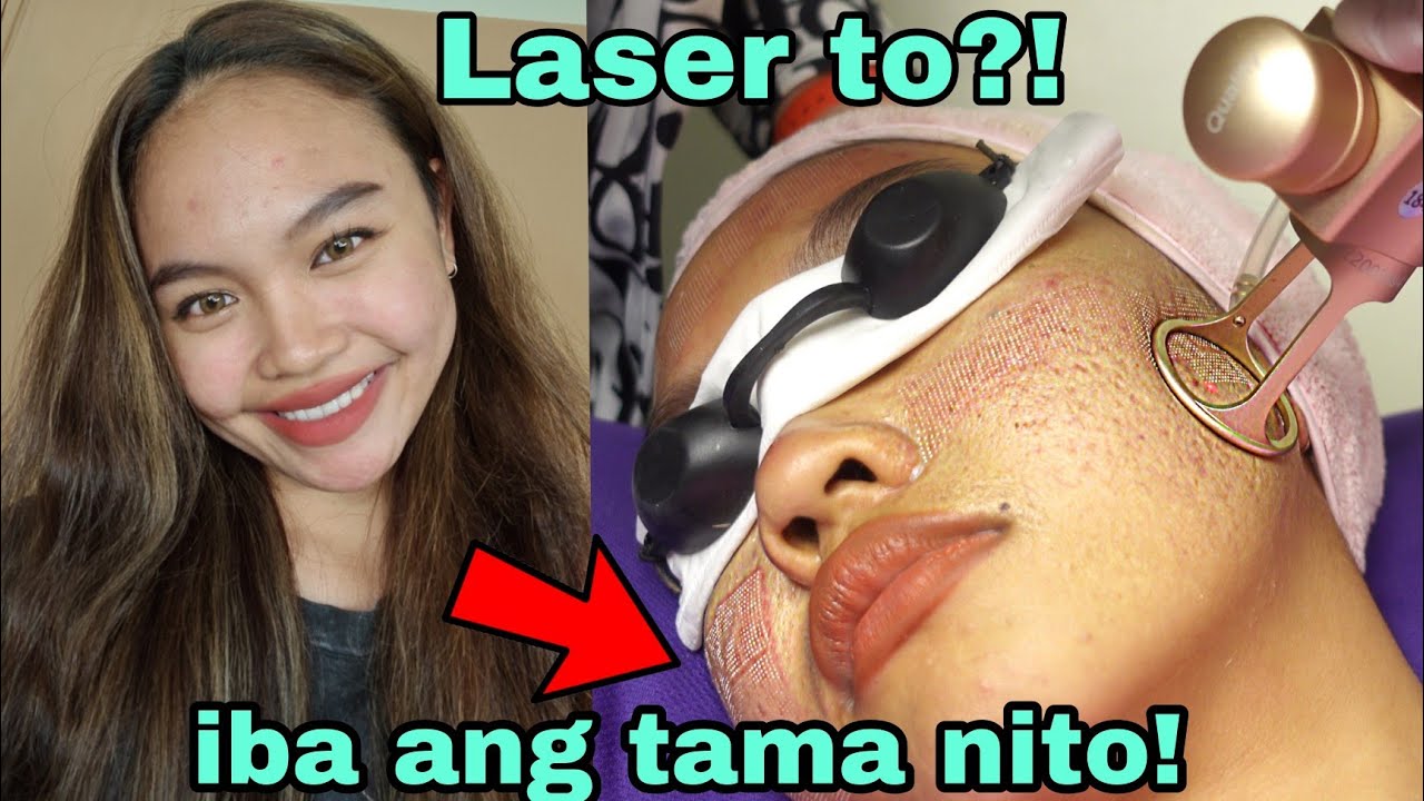 ni LASER ulit ang Face ko! màsakit ba‽