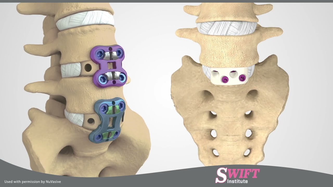 Anterior Lumbar Interbody Fusion (ALIF) in Reno, Nevada - Minimally Invasive Spine Surgery