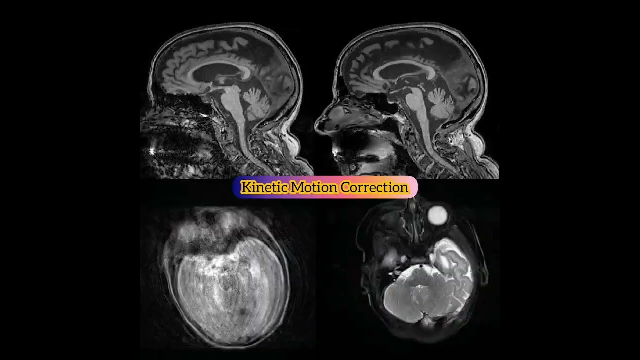 kinetic motion correction in MRI