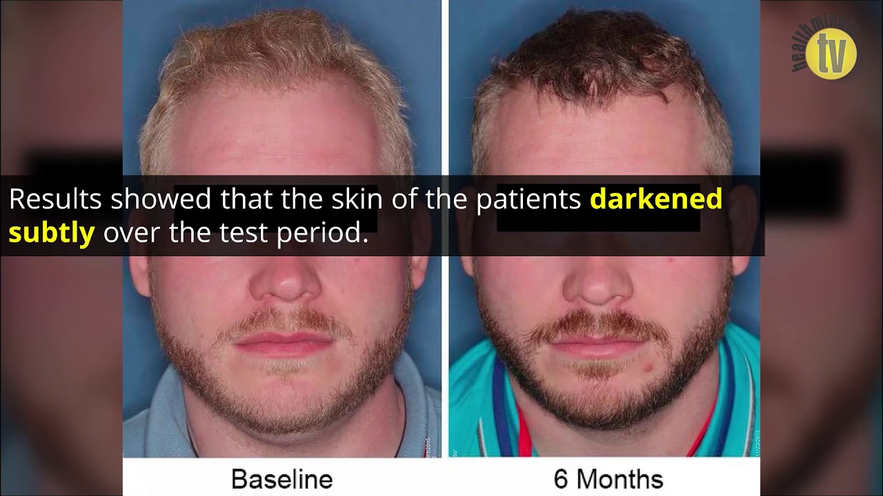 New Therapy Increases Melanin in Patients with Albinism