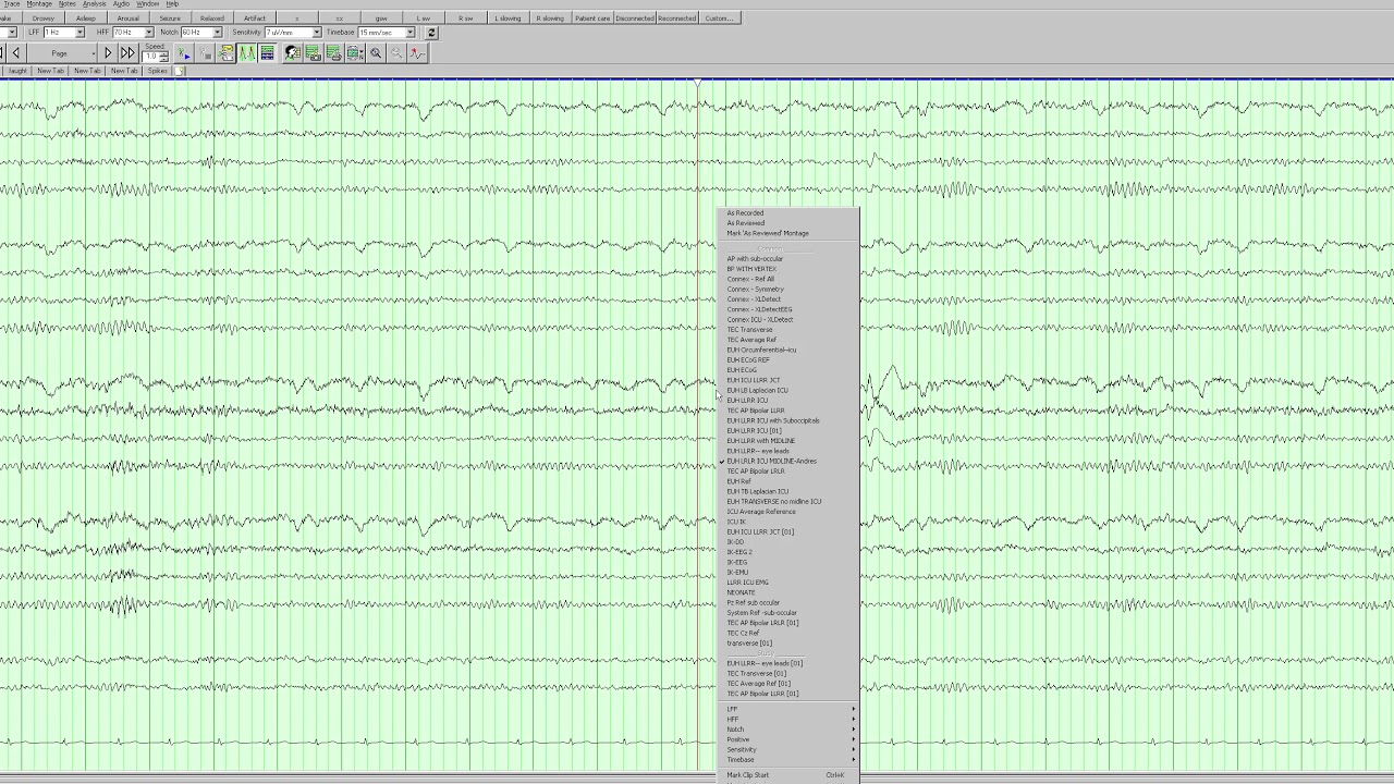 Left temporal epileptiform activity