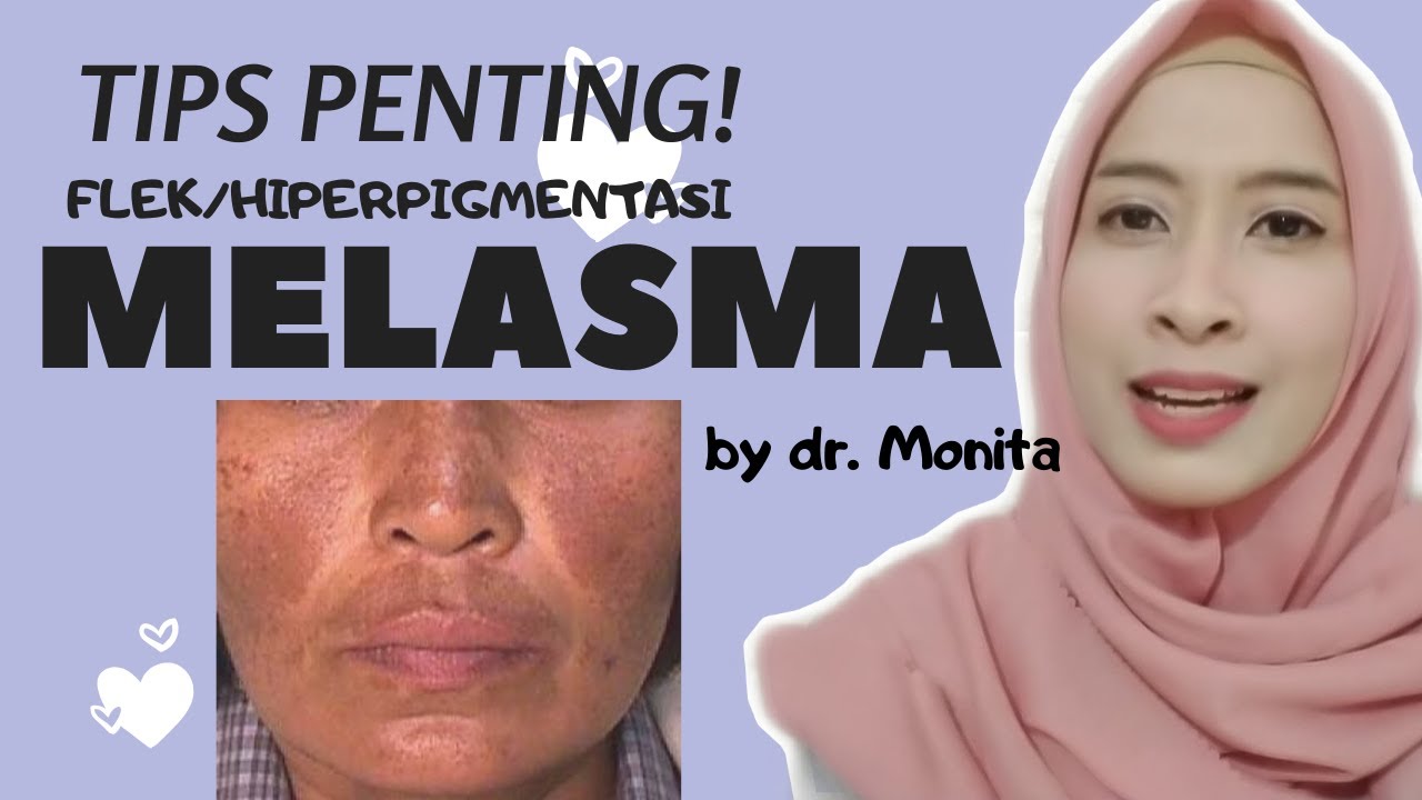 Cara Menghilangkan Flek Melasma di Wajah Dengan Aman dan Cepat | by dokter Monita