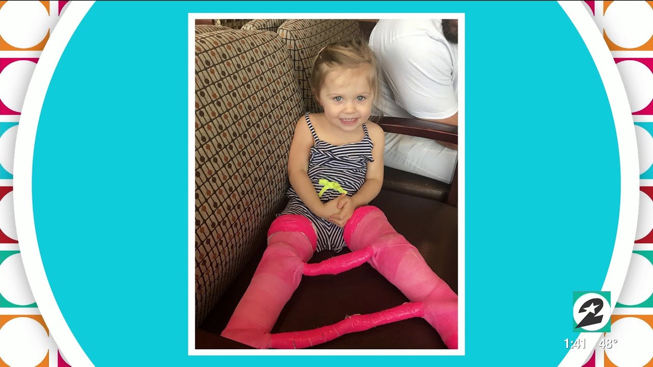 The surgery giving this 3-year-old full mobility after developmental d...