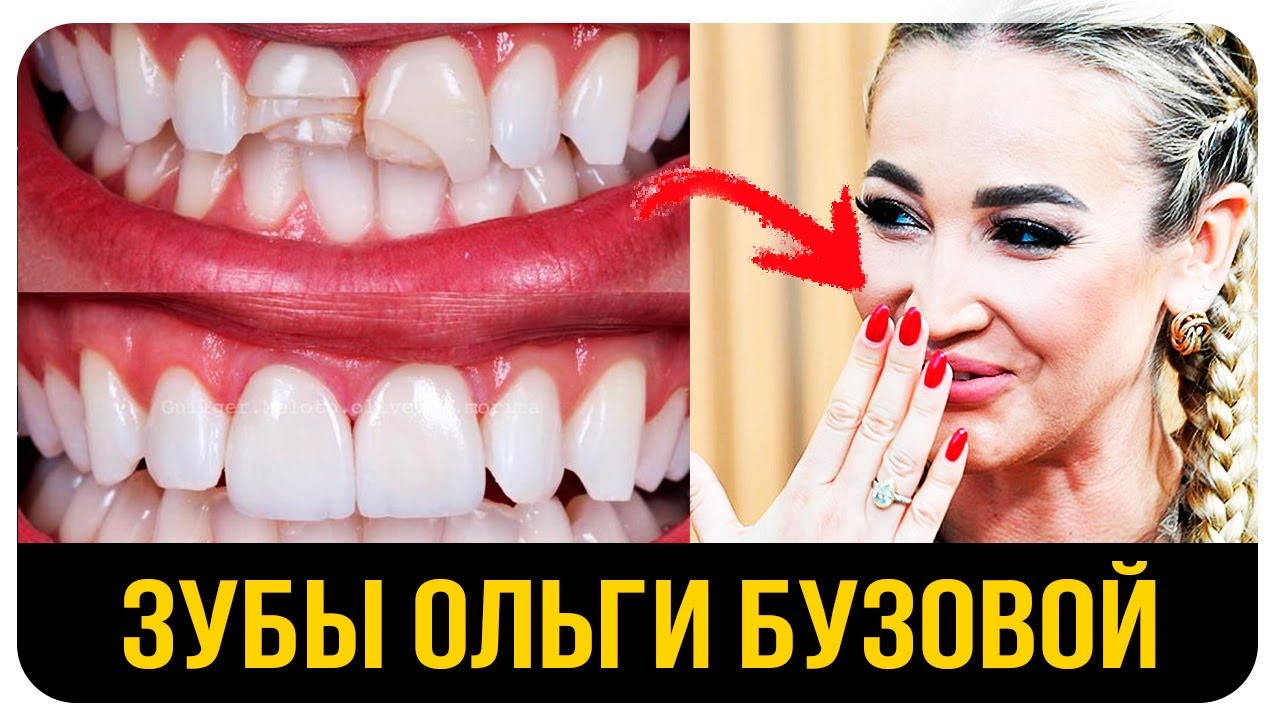 Ольга Бузова. До и После. Кривые Зубы Знаменитостей. Сколько Стоит Выравнивание Зубов или Виниры?