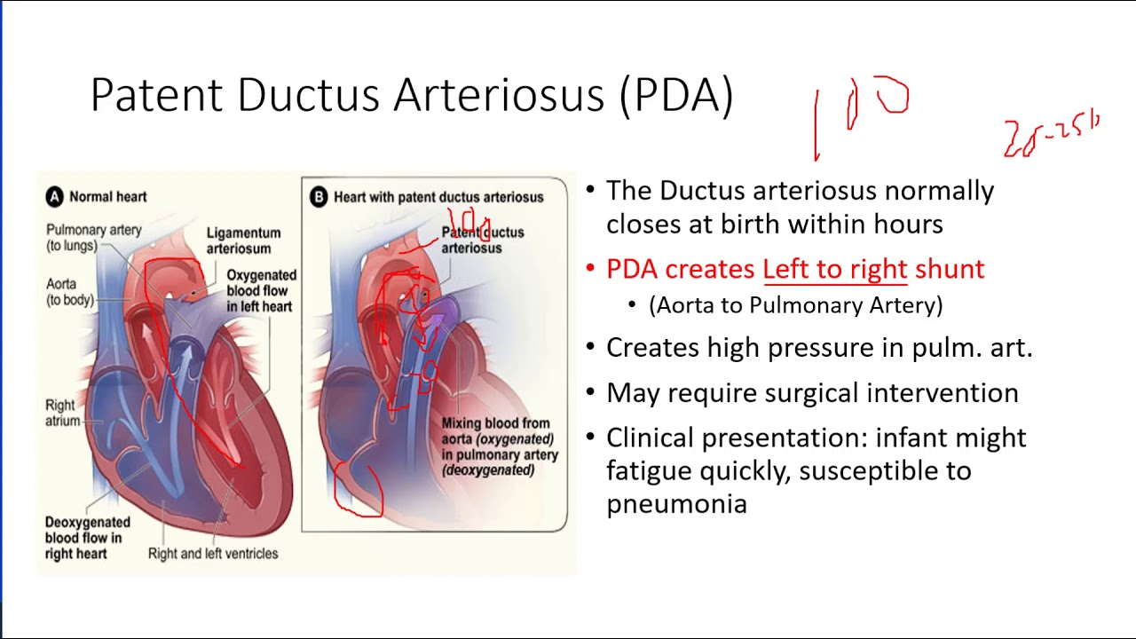 Pediatric Cardiology 2: Acyanotic Defects