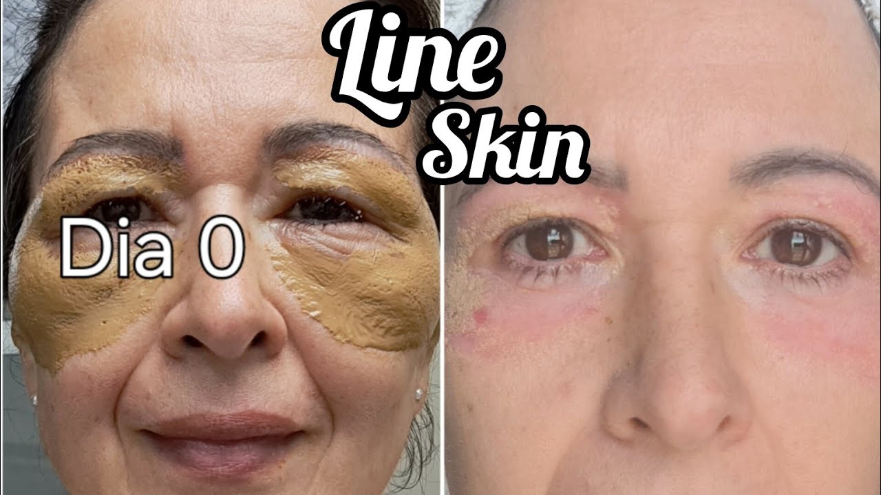 LINE SKIN: peeling de Fenol - Tereza Scardua - avaliação - valores - como é feito - pós - TUDO!