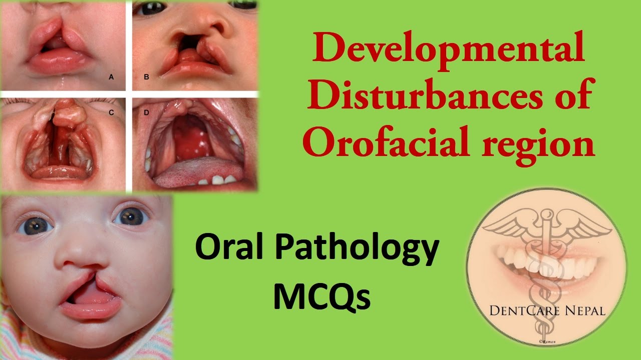 Oral Pathology MCQs - Developmental Disturbances of Orofacial region - Cleft lip and palate