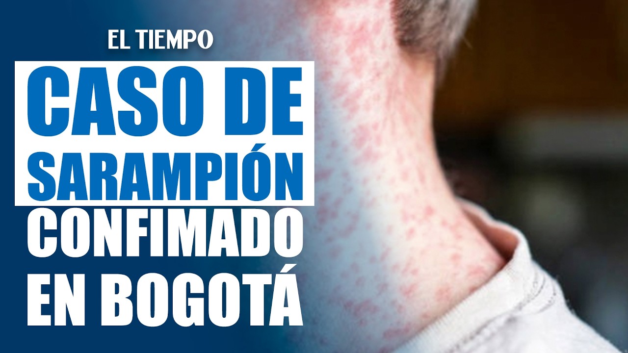 Bogotá confirma caso de sarampión en paciente extranjero | EL TIEMPO