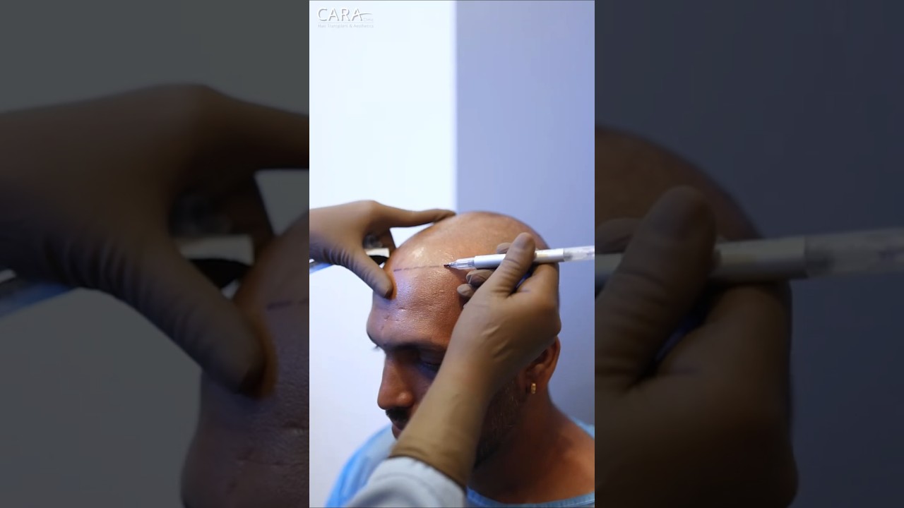 Hairline Design Secrets at Mumbai&rsquo;s CARA Clinic