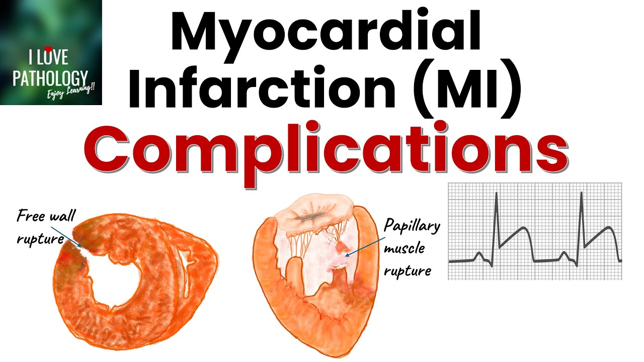 MYOCARDIAL INFARCTION  | Complications | Ischemic heart disease  | part 6