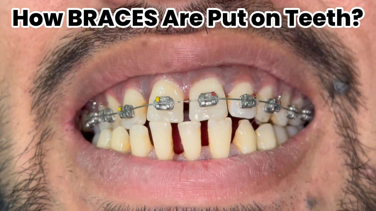 How Braces Are Put On Teeth - Step By Step Process | Female Orthodontist in Lahore | Orthodontic