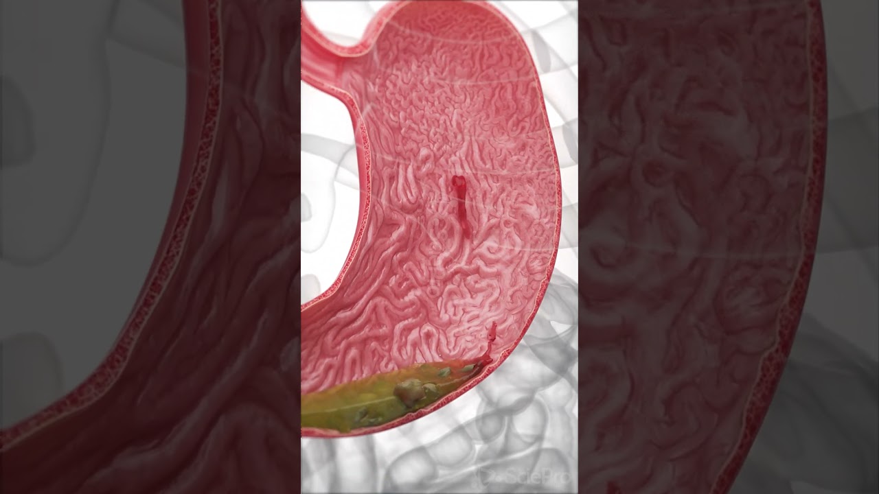 A peptic ulcer is a sore in the lining of the stomach or duodenum.  #medicalanimation #anatomy
