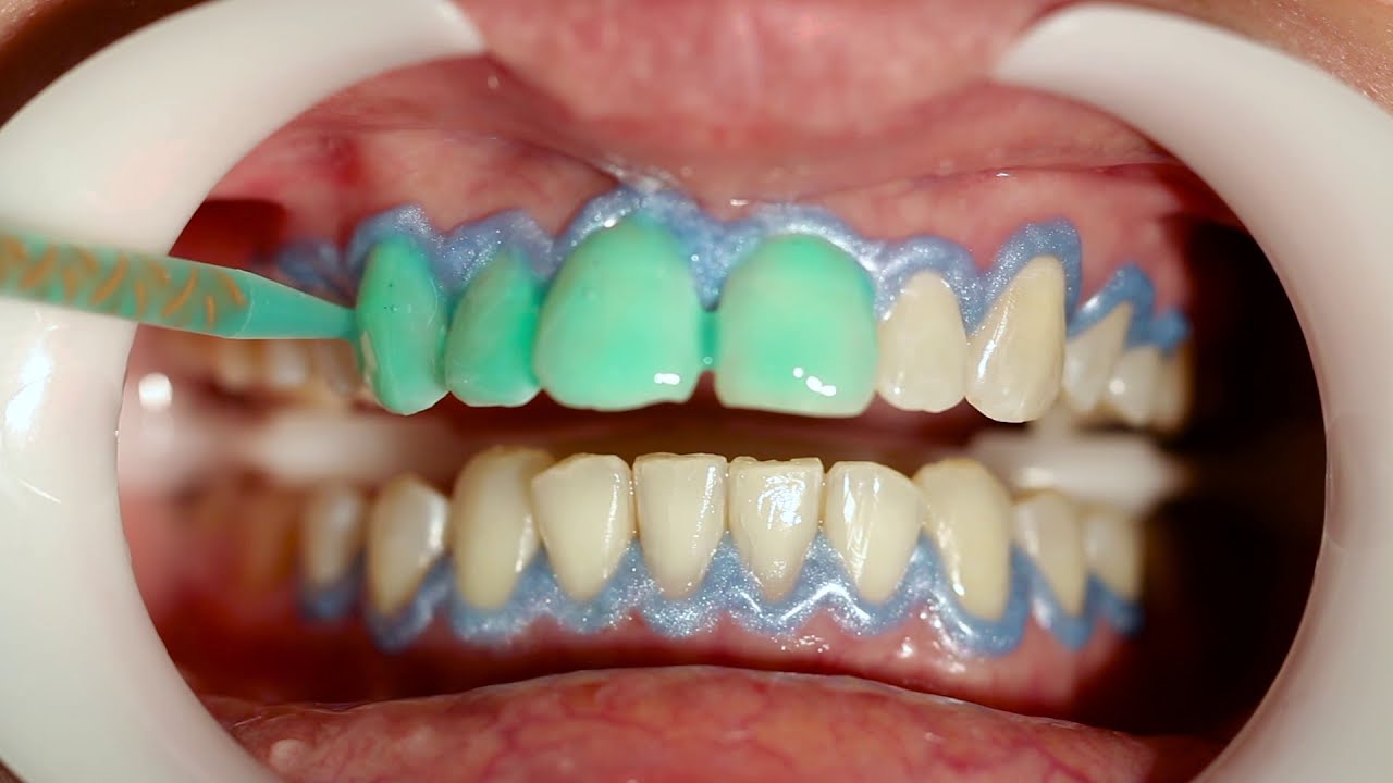 Clareamento combinado e fechamento de diastema em resina composta Vittra APS