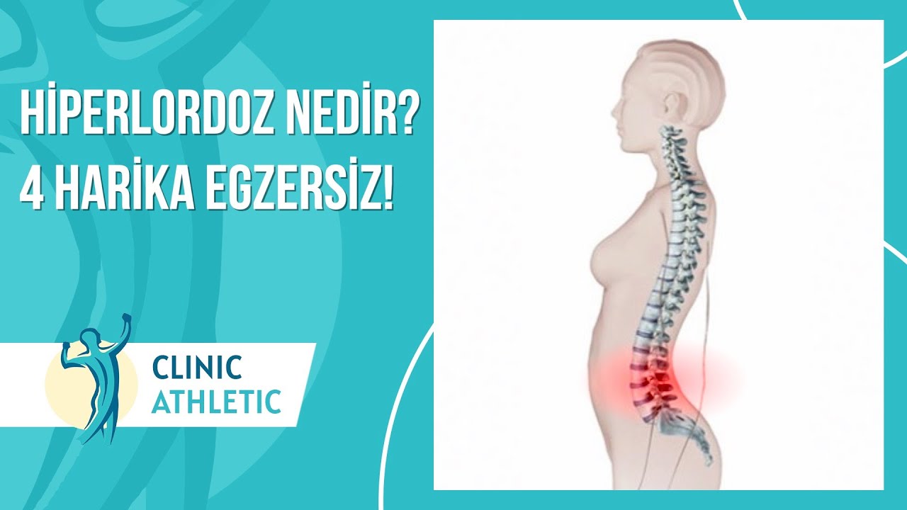 Hiperlordoz Nedir? Neden Oluşur? | 4 Harika Egzersiz!