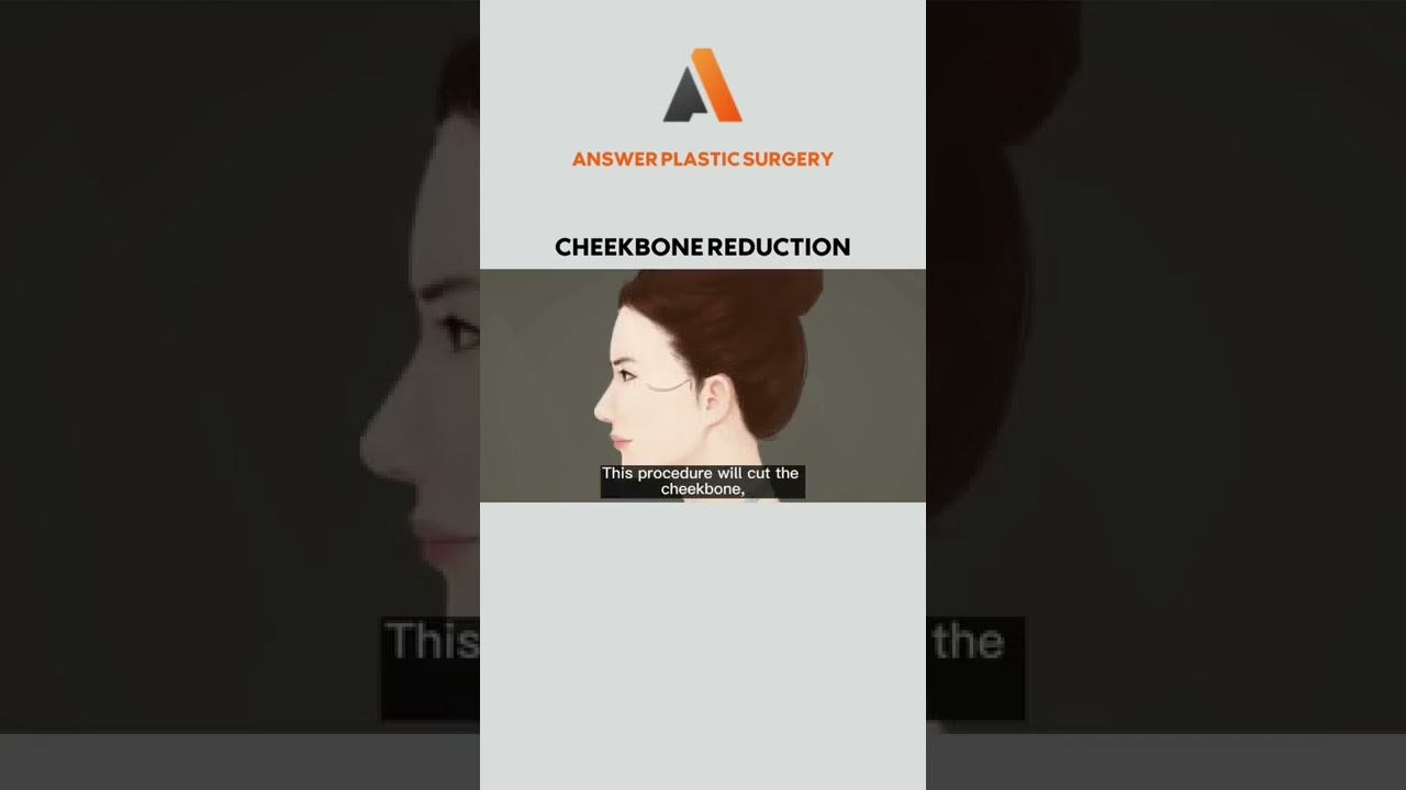 Cheekbone Reduction | Answer Plastic Surgery 
