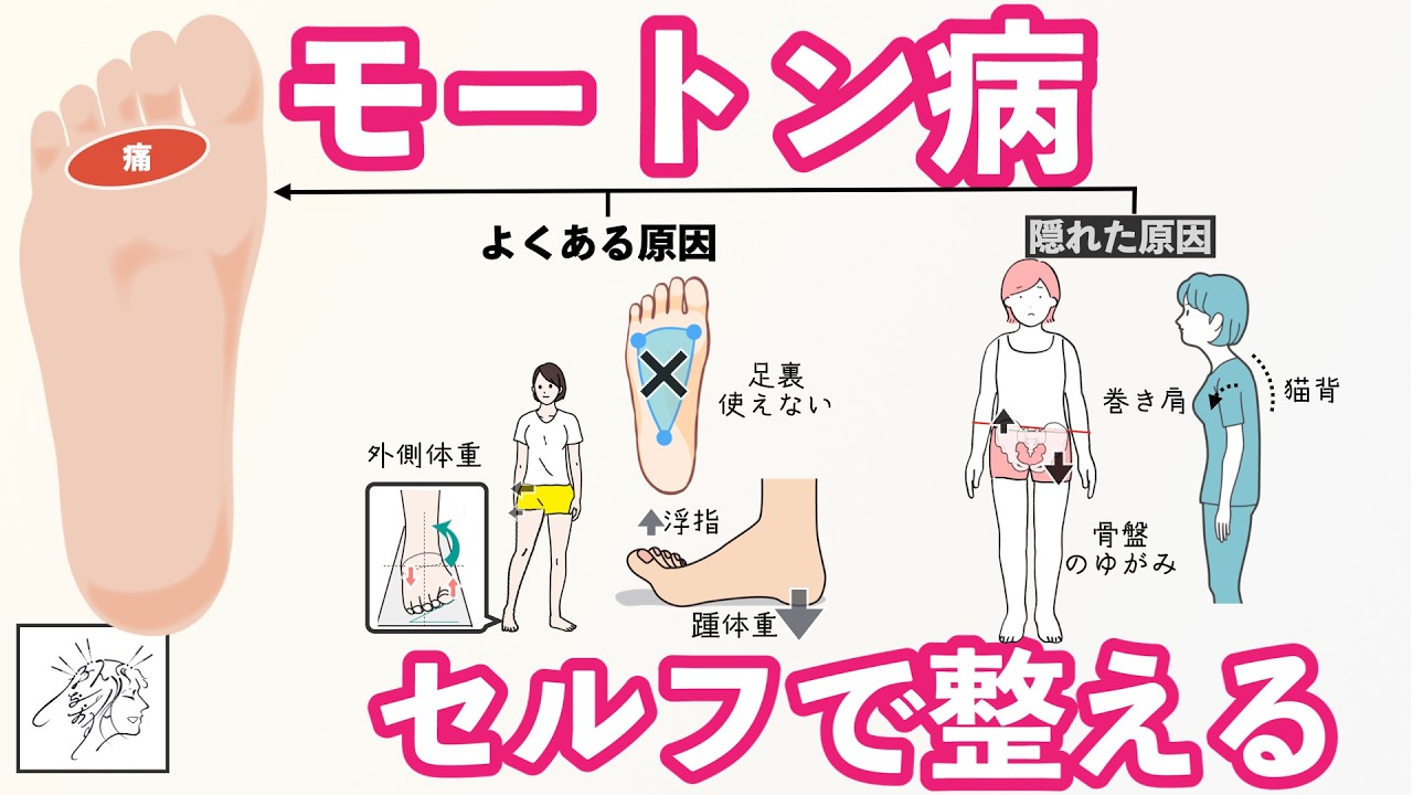 【足裏の痛み】モートン病の隠れた原因と問題別３つのセルフ整体