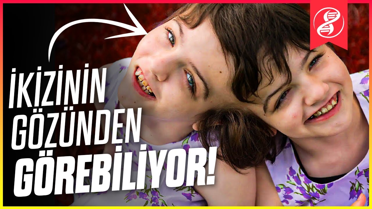 Yapışık İkizler Birbirlerinin Düşüncelerini Okuyabilir mi?