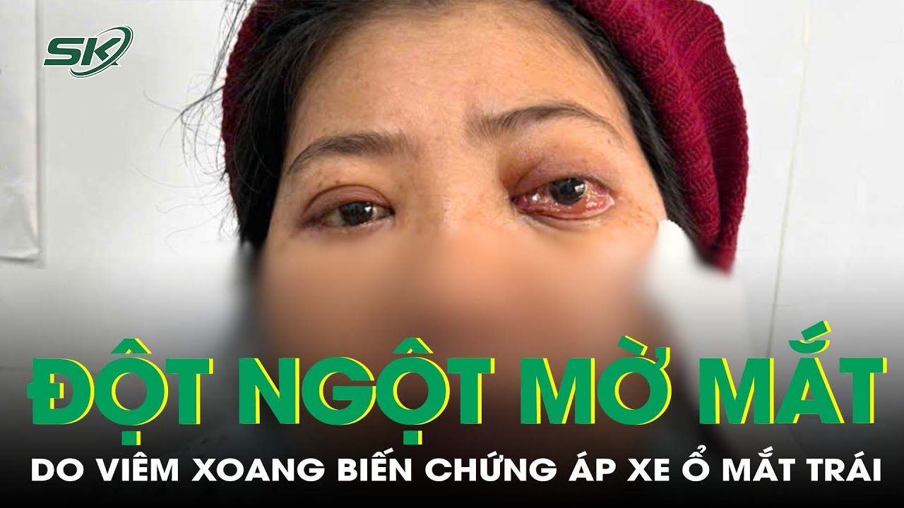 Người phụ nữ mờ mắt đột ngột do viêm xoang biến chứng | SKĐS