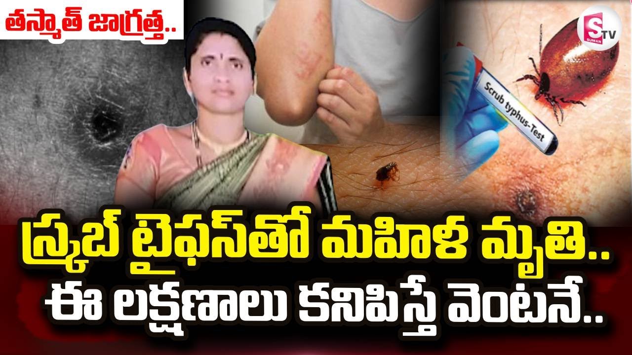 స్క్రబ్ టైఫస్  ఈ లక్షణాలు కనిపిస్తే I Scrub Typhus Dangerous |Scrub Typhus: Symptoms |  SumanTV Vali