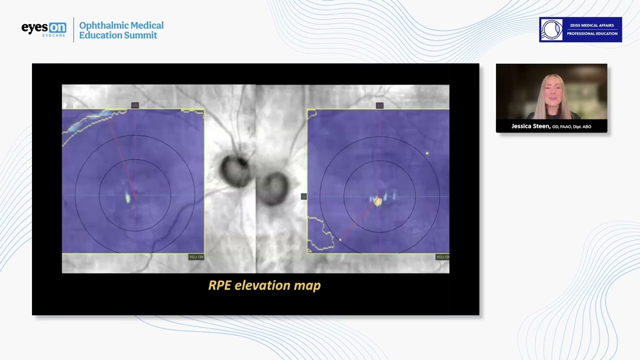 Imaging for the Inner and Outer Retina: Case #1