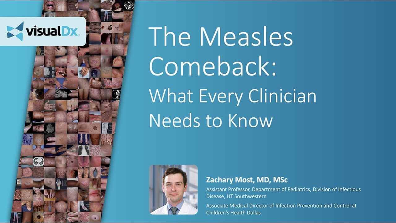 The Measles Comeback: What Every Clinician Needs to Know