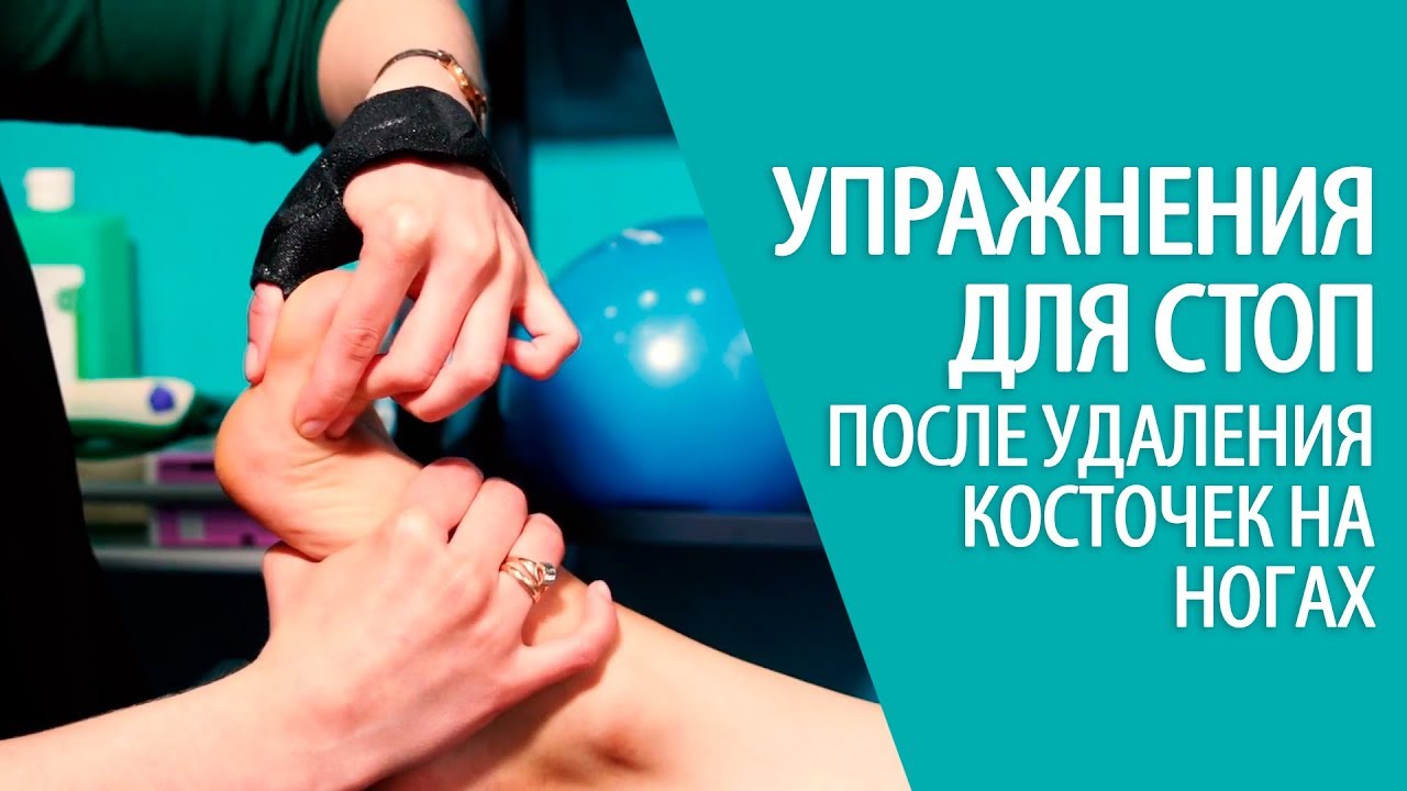 УПРАЖНЕНИЯ ДЛЯ СТОП после удаления косточек на ногах HALLUX VALGUS Алексей Олейник