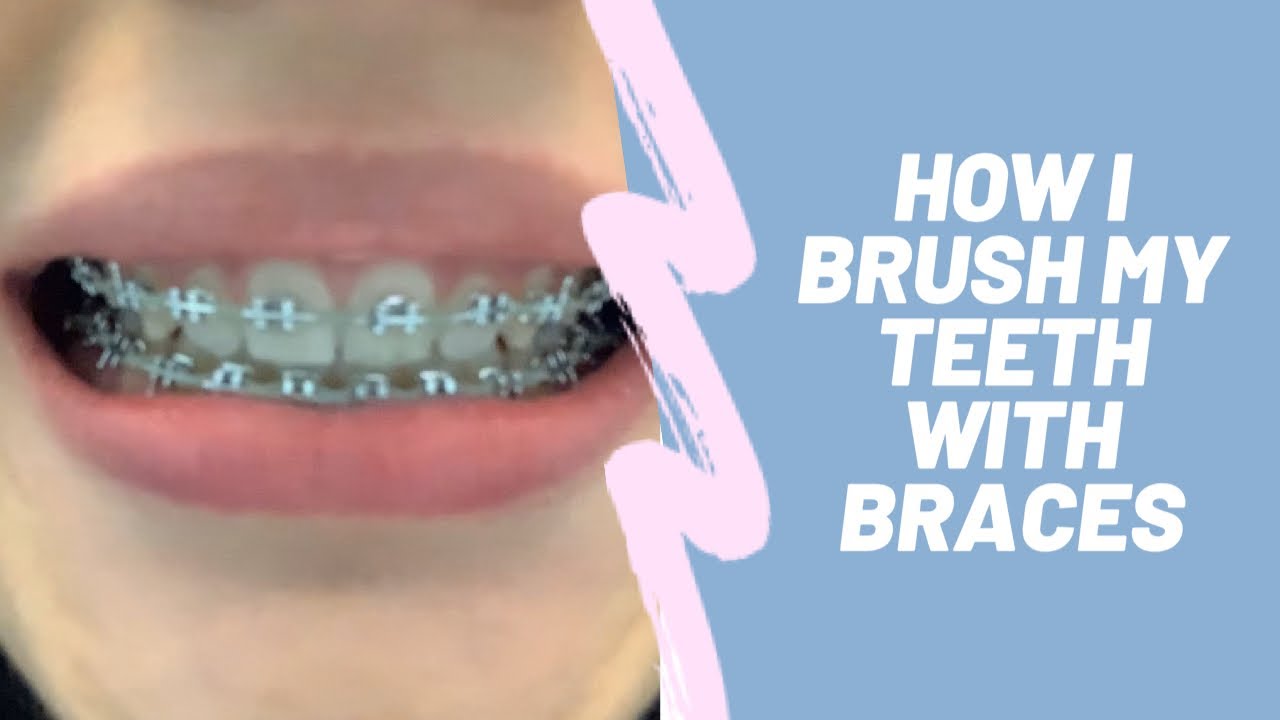 How I Brush My Teeth With Braces!!