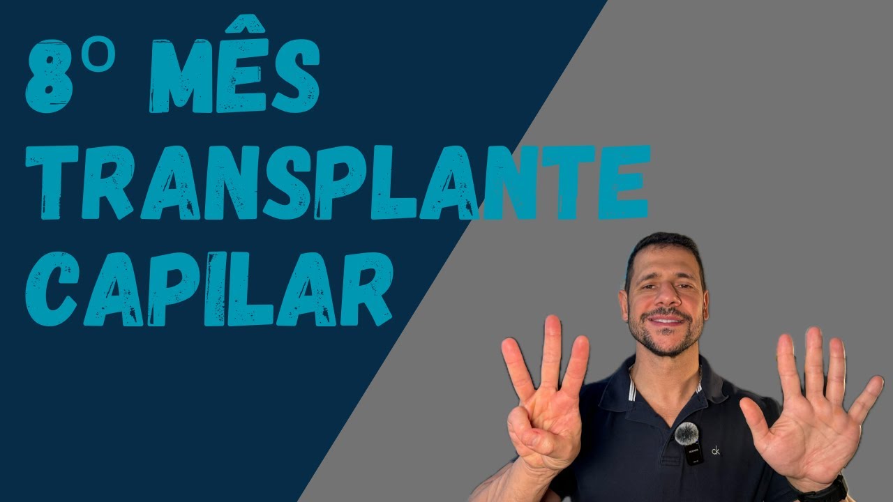 8 MESES APÓS O TRANSPLANTE CAPILAR 😱 O RESULTADO FINAL ESTÁ CHEGANDO!