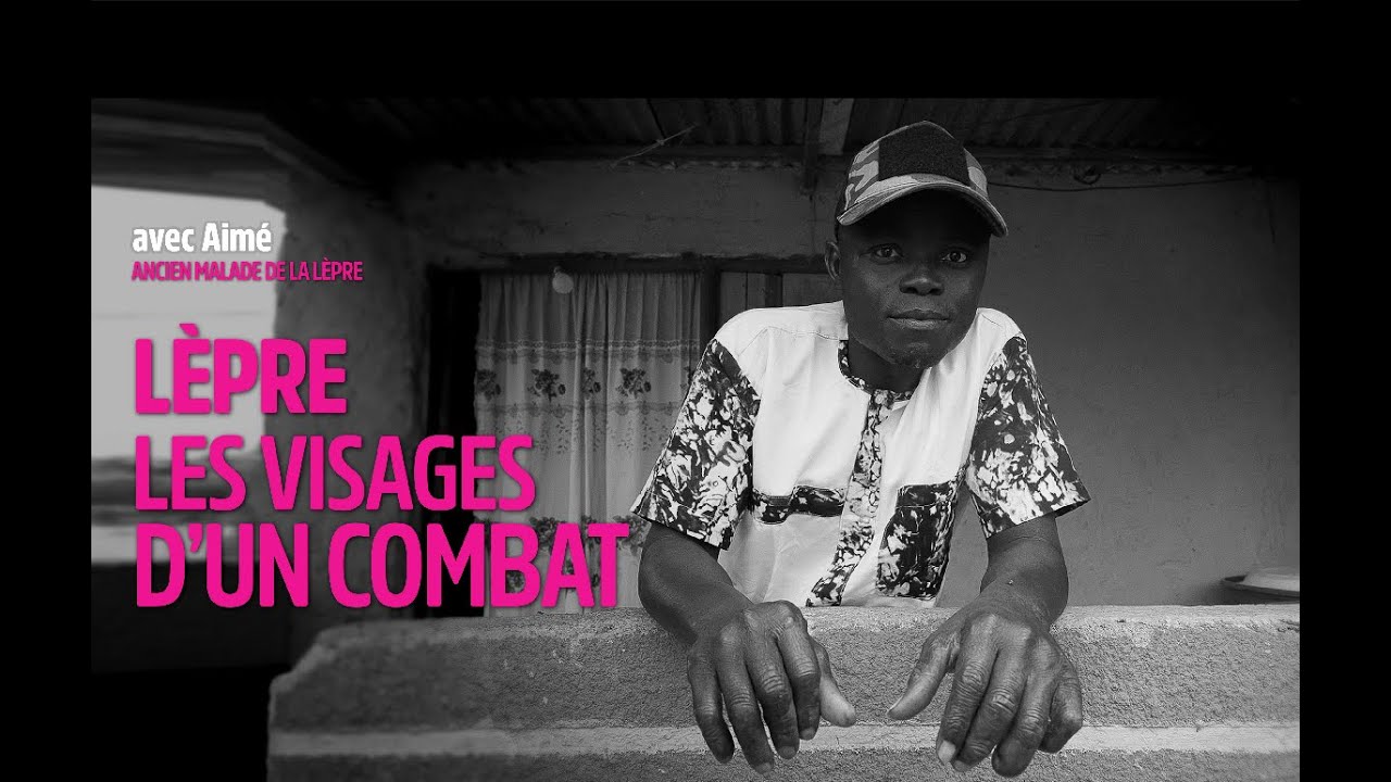 Lèpre- Les visages d'un combat - Aimé