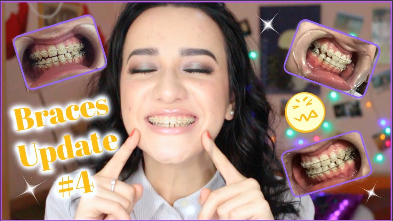ROM/ENG: Dureri,Elastice - Experienta Mea cu Aparatul Dentar | Pain,Elastics - Braces Journey #4