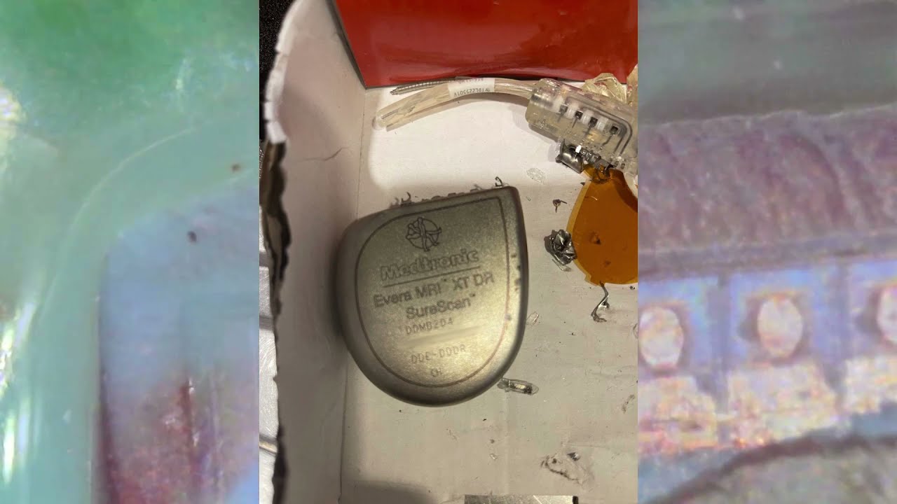 1000x Magnification - EXPLODED Medtronic Evera MRI XT DR Pacemaker + Defibrillator Under Microscope.