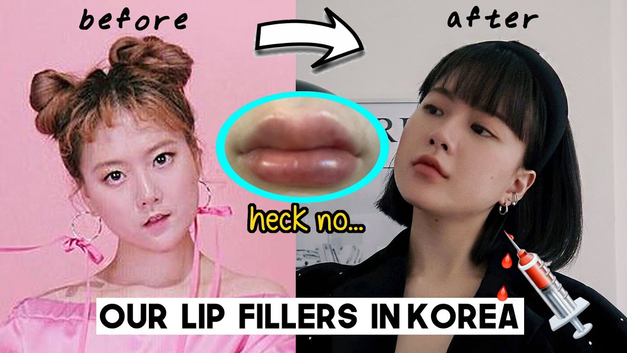My Lip Filler Journey in Korea (Plastic surgery clinic, Cost, Pros & Cons etc) | Q2HAN
