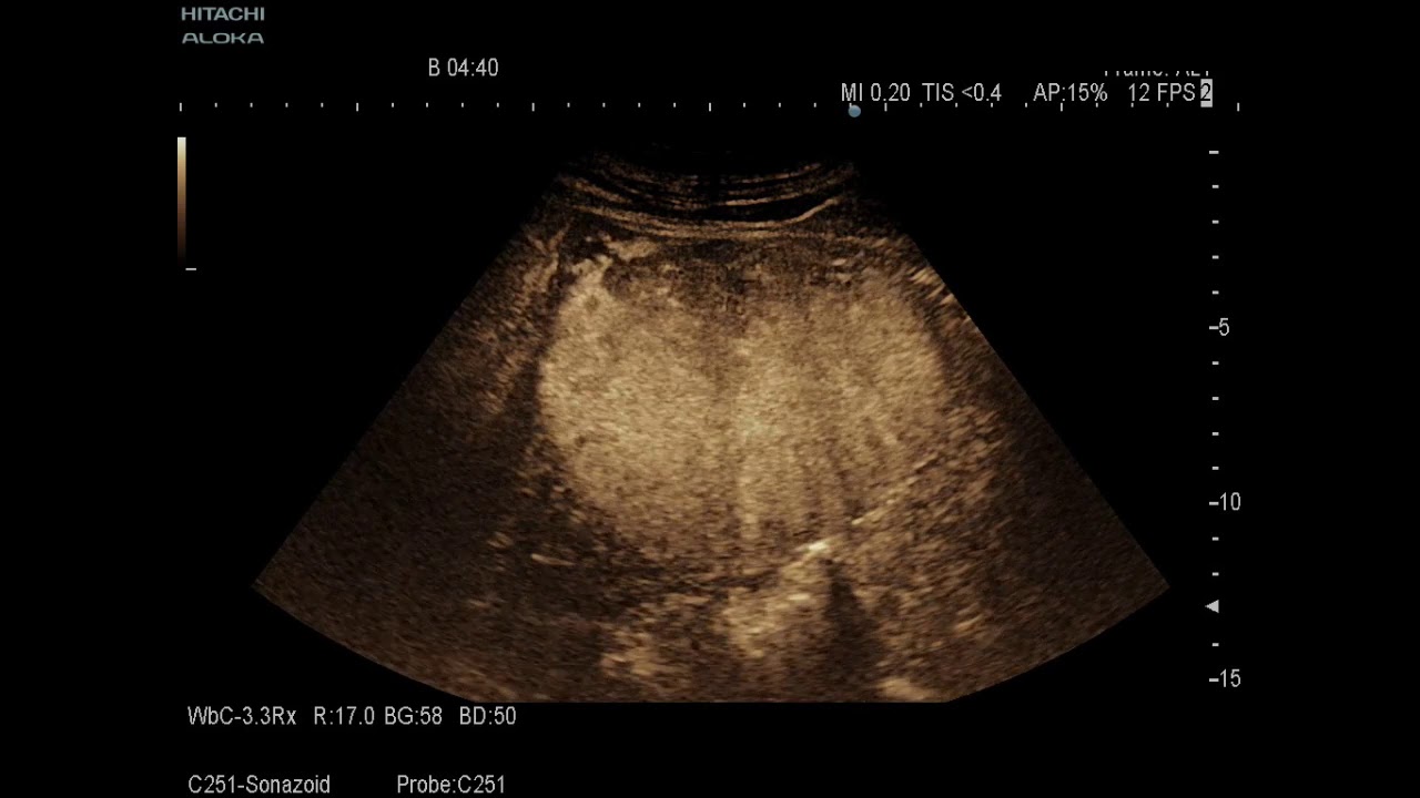 Dormed Hellas - ARIETTA 70 - Radiology 2D, Color, Contrast and Elasto mode