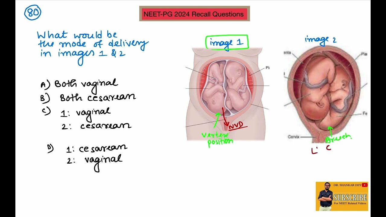 NEET-PG 2024 Recall || Questions 71 to 80 || Dr. Shankar Dey