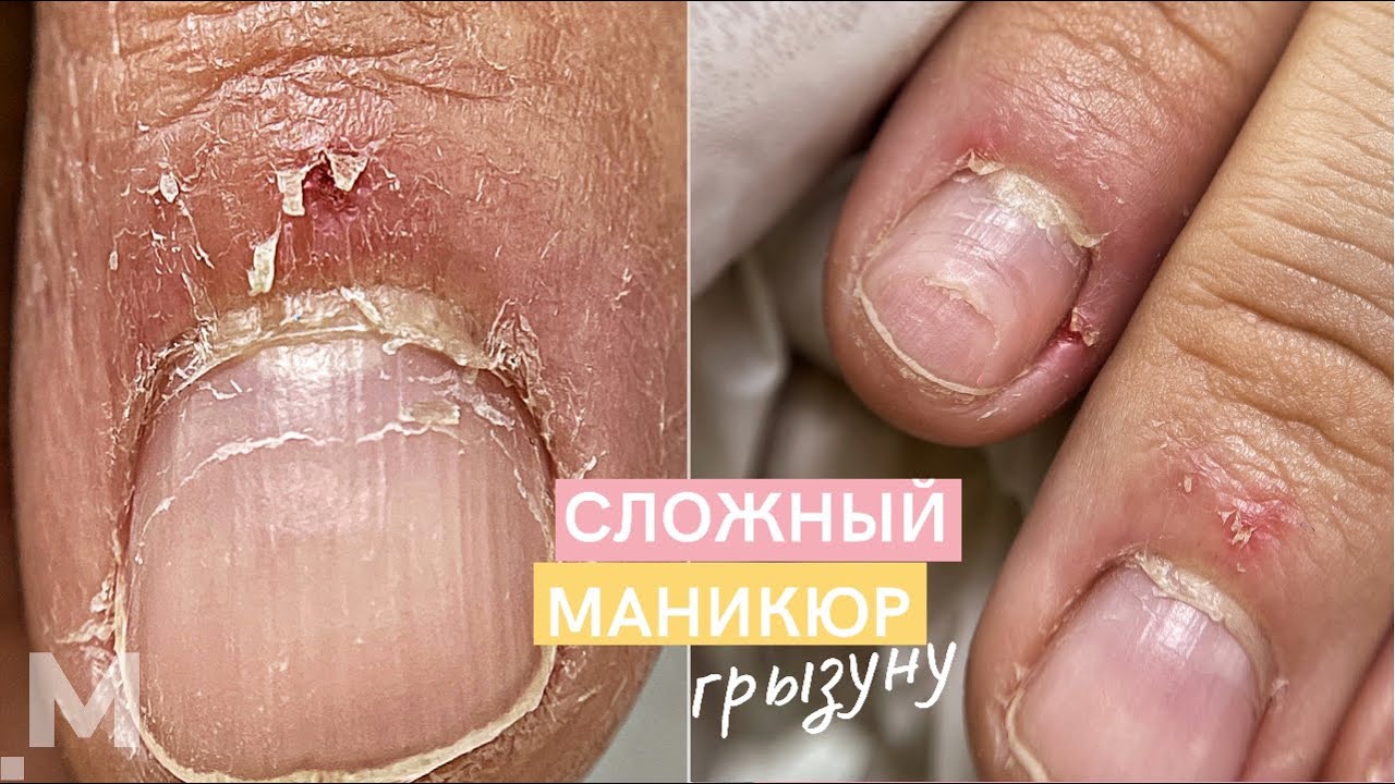 КРОВАВЫЕ заусенцы и ЖЕСТКАЯ НАЛИПШАЯ кутикула 🍖 Маникюр ГРЫЗУНУ. Наращивание сгрызенных ногтей