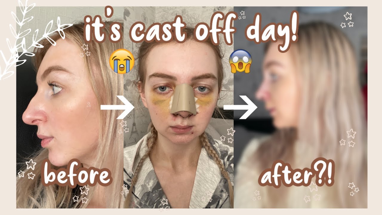 NOSE JOB REVEAL! Cast Off Day & Live Reaction | Rhinoplasty Vlog 2021 UK