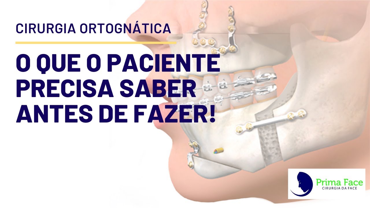 O que você deve saber antes de fazer a cirurgia ortognática?