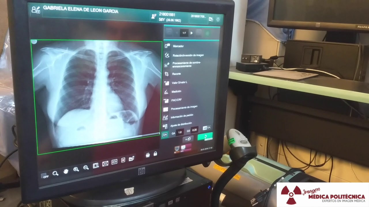 Cómo grabar estudio en CD con PACS Efilm.