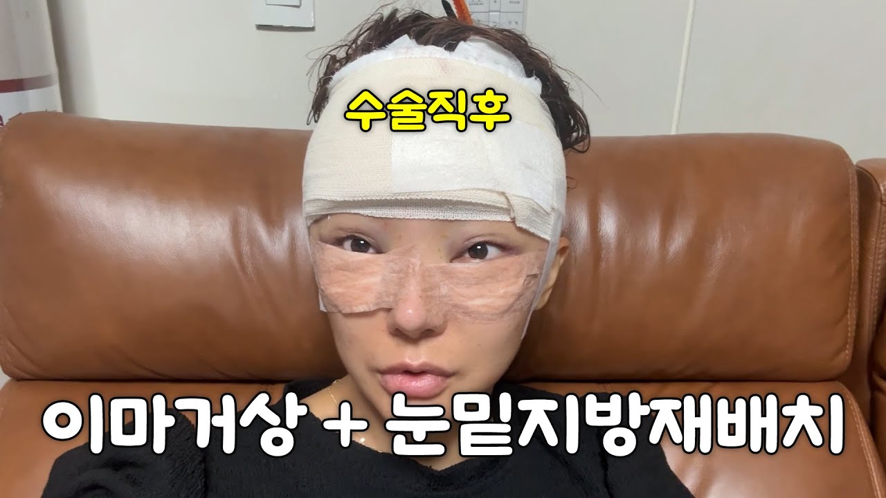 수술 효과 제대로 보고 왔습니다. 한달차 영상도 공개👏🏼[몽슈Vlog]