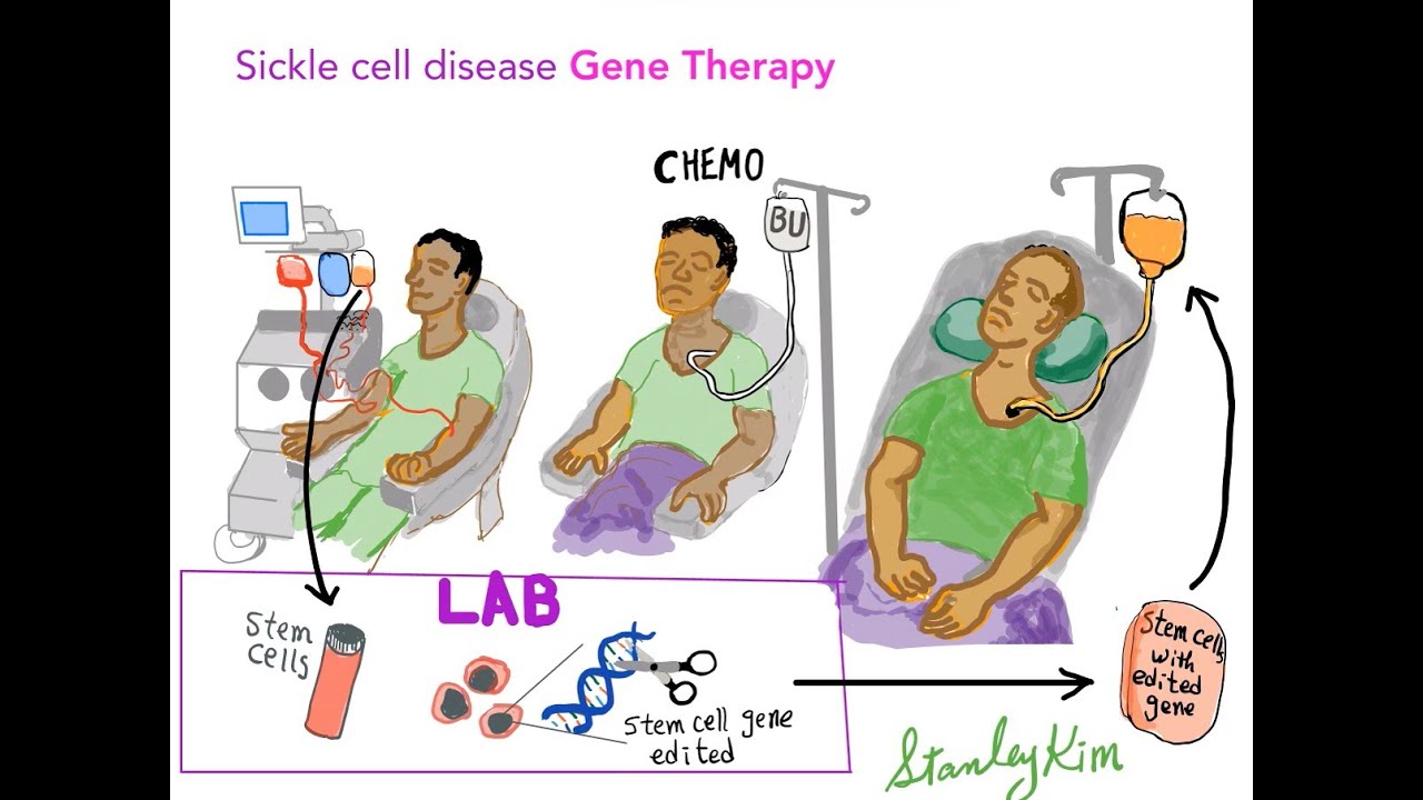 Sickle Cell Disease: Past, Present, Future, and Gene therapy
