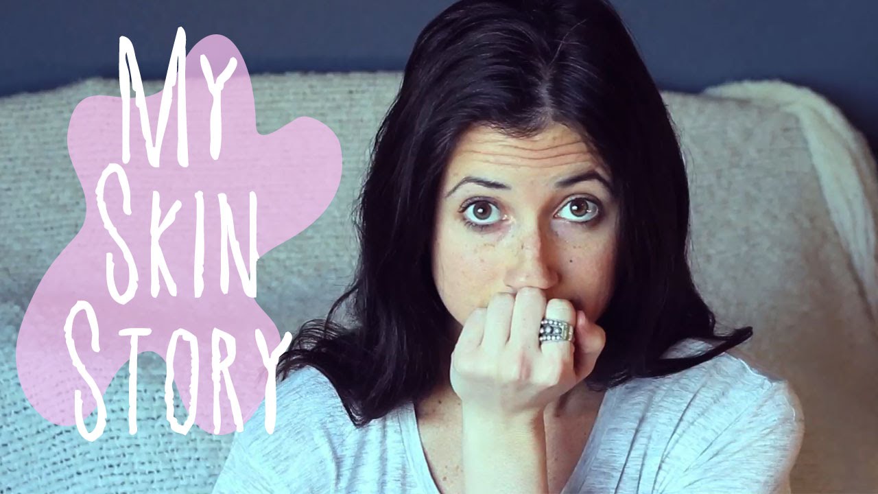 My Skin Story | Acne, Diet, and Skin Care