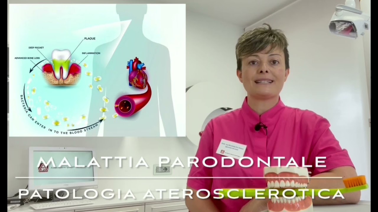 Giornata Nazionale dell'igienista dentale 2021 - PATOLOGIE CARDIOVASCOLARI - ATEROSCLEROSI