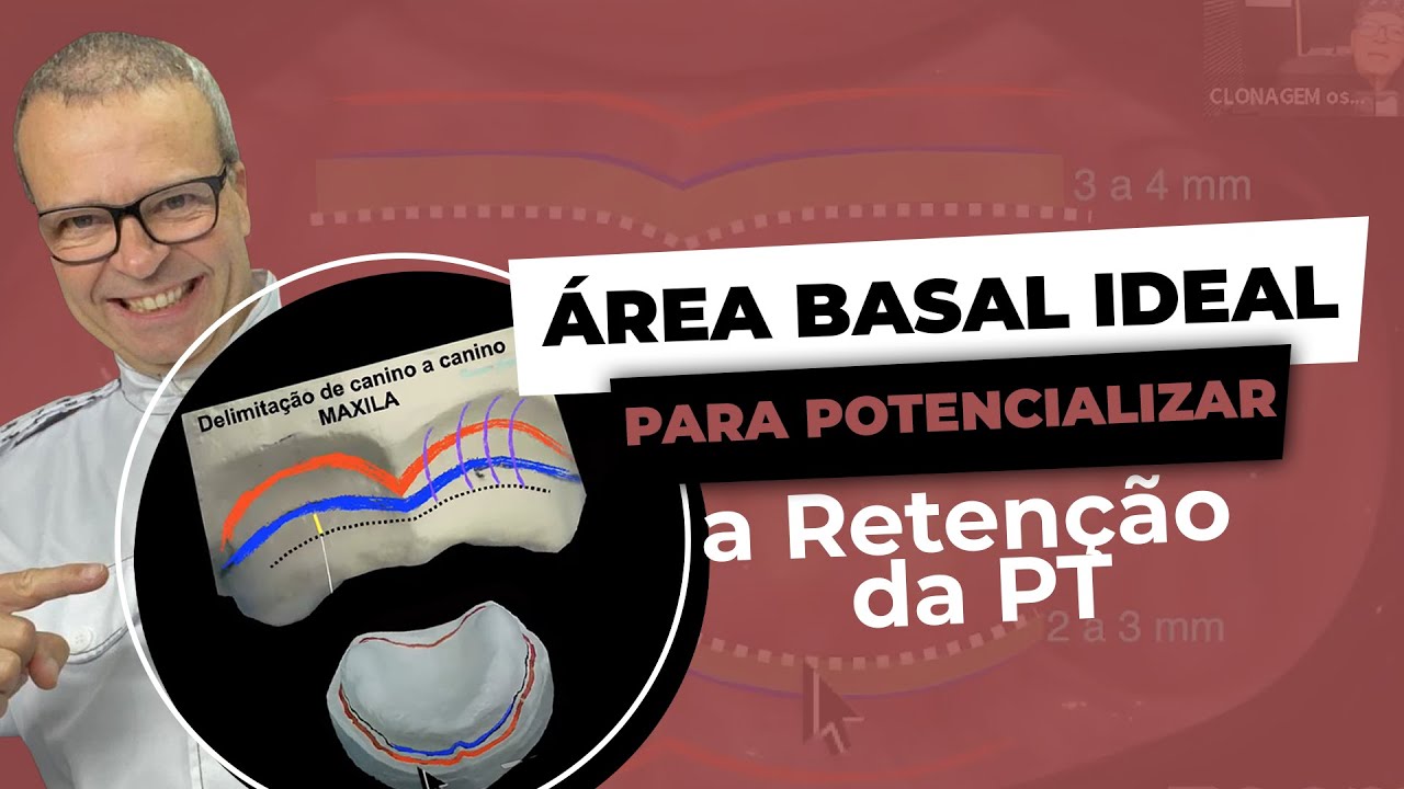 Área Basal em Prótese Total: como delimitar corretamente