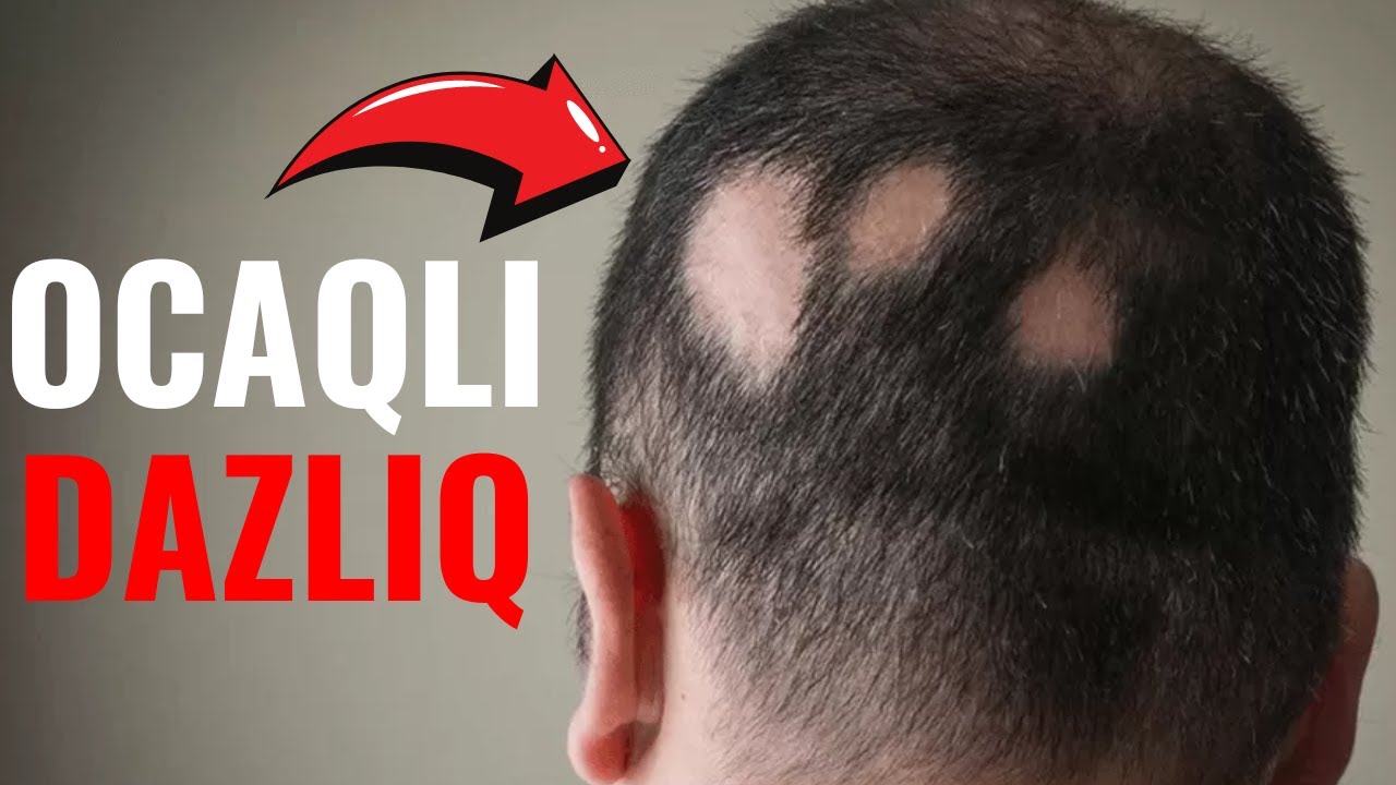 Ocaqlı Dazlıq Nədir?