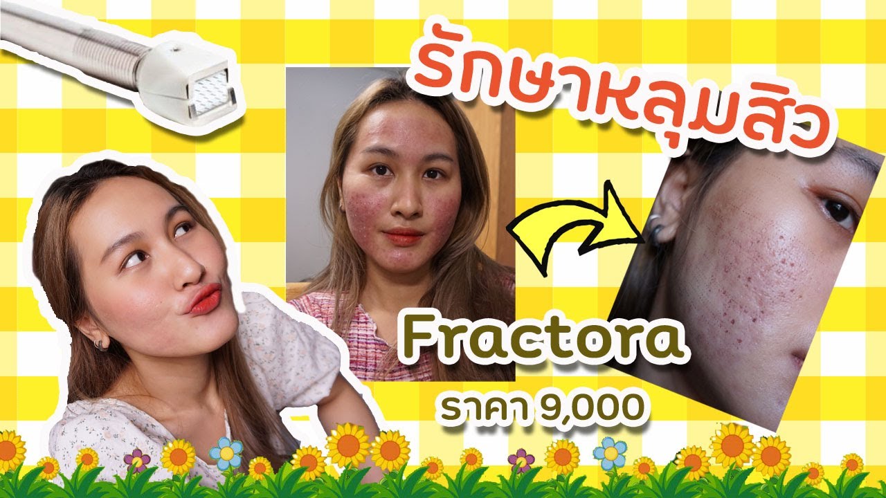 รักษาหลุมสิว EP.2 | ด้วยเลเซอร์ Fractora ผลลัพธ์จะเป็นยังไง | MorPorr