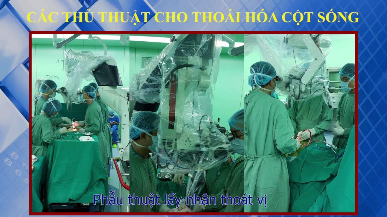 Thoái hóa cột sống và cách phòng ngừa , điều trị