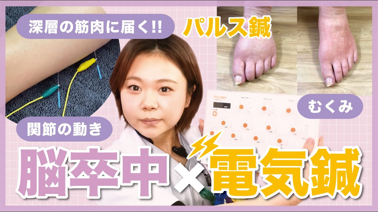 【脳卒中】筋肉の深層に届け！！驚きの効果を生み出す？電気鍼のはなし。（脳梗塞／脳出血／片麻痺／浮腫(むくみ)／関節／鍼灸師／電気針／治療）
