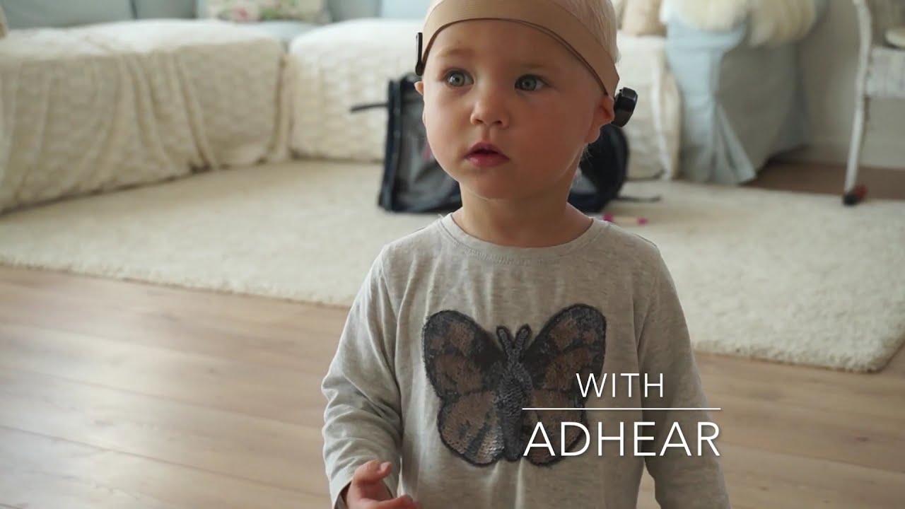 MED-EL's ADHEAR: Hearing with Microtia and Atresia