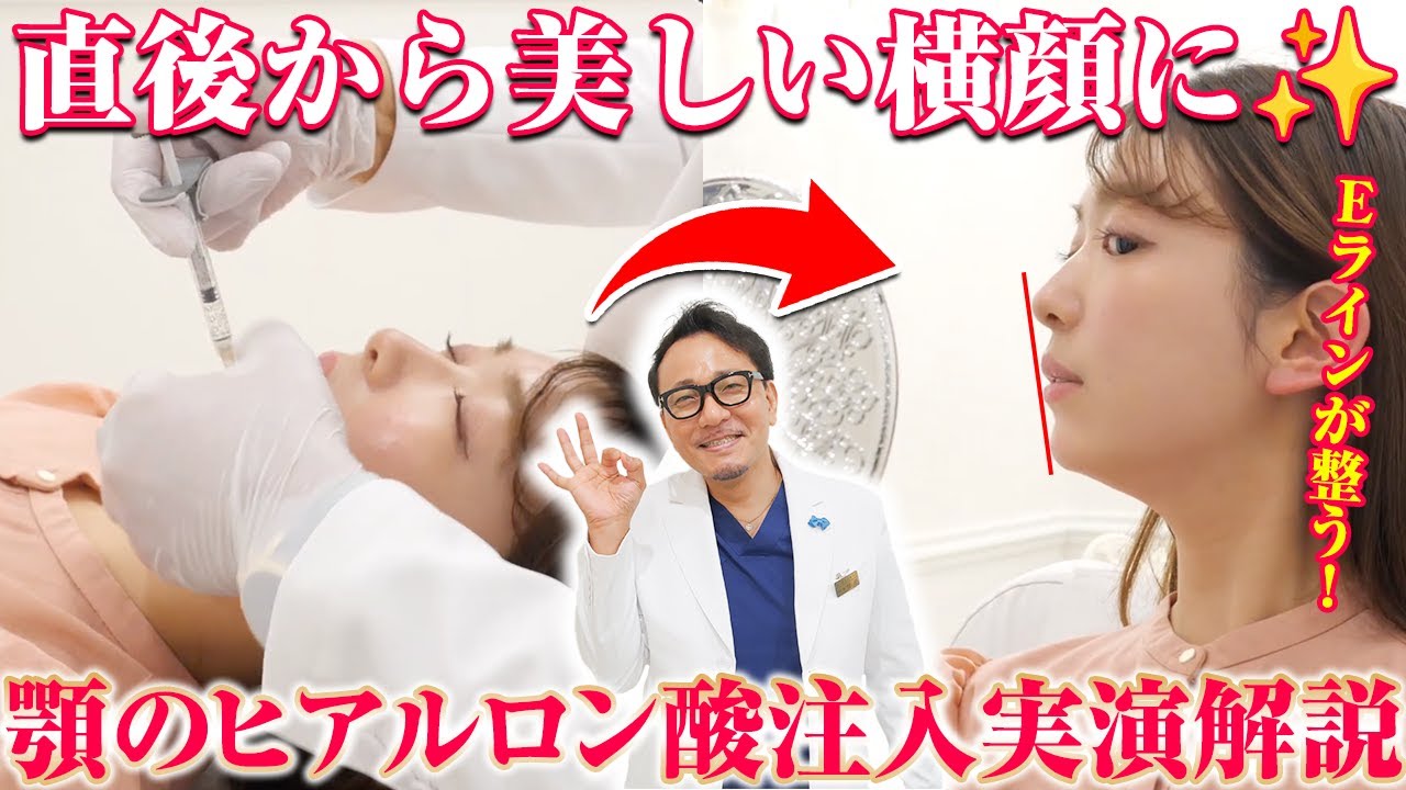 顎のヒアルロン酸注入はどんな効果がある？実際にお見せします。