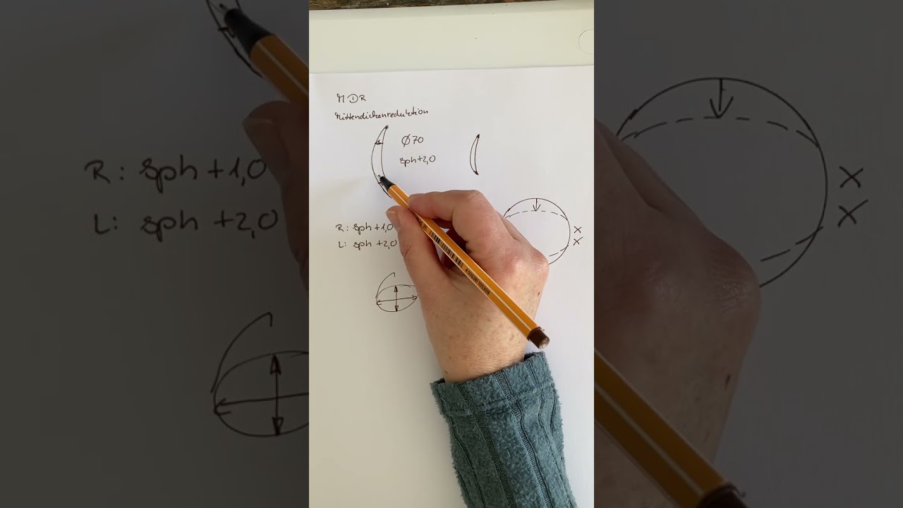 Mittendickenreduktion bei sphärotorischen Brillen